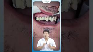 Sự Thật Về Cầu Răng Sứ Kim Loại Nha Khoa Minh Châu
