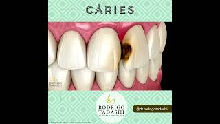 Evolução Da Doença Cárie - Dr Rodrigo Tadashi