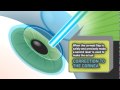 Lasik Safety And Efficacy | RM. Lasik Safety And Efficacy | RM.