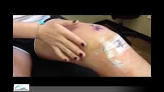 ACL Rehab Forum: Therapy - Week 1