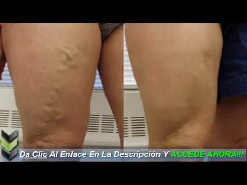 Venotoniki a varikoze de los pies el precio los pinchazos