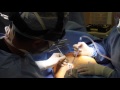 Breast Augmentation with Breast Implants