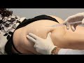 Injecting Sculptra on the Buttocks with Dr. Butterwick