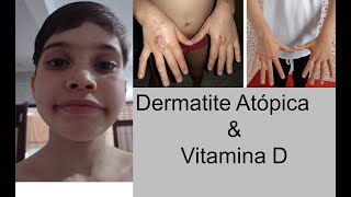Samuel - Dermatite Atópica