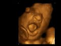 ultrasound 3d 4d