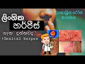 genital herpes sinhala |ලිංගික හර්පීස්. | Sinhala medical channel