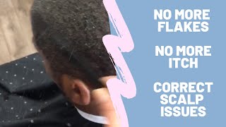 No more Dandruff / Flakey Scalp ... watch till end for results