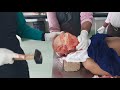Steps of Autopsy Dissection