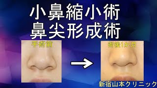 【鼻尖形成と小鼻縮小を同時に手術】鼻の手術を2つ受けると変わりすぎて不自然になる?