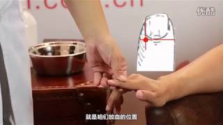 中医放血操作方法