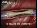 ITGI Medical- Pericardium Covered Stent, video produced by Virtual Point