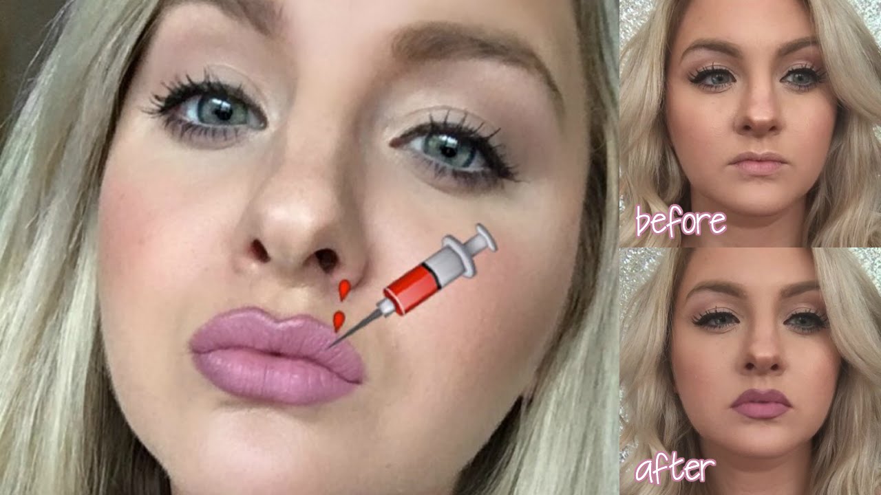 Ashley Rickards Lip Injections