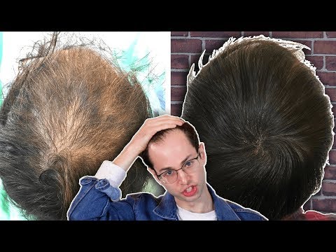 Microblading My Scalp For Balding