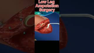 Low Leg Amputation Surgery Due To Accident , Injured Leg