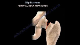 Hip Fractures Types ,Clification And Treatment