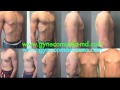 Adolescent Gynecomastia With Dr Blau Jose S Story Adolescent Gynecomastia With Dr Blau Jose S Story