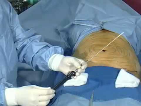 Liposukcja - przebieg operacji 