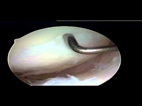 microfracture surgery