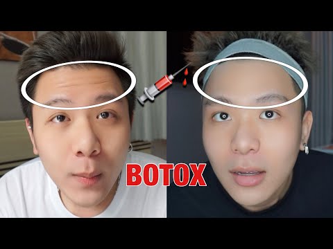XOÁ NẾP NHĂN TRÁN! 💉