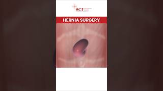 Hernia Operation Kaise Hota Hai? Animated Guide