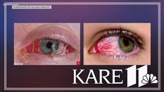 Red, itchy eyes: Is it pink eye or something else?