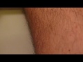 Fasciculation Treatment | RM. Fasciculation Treatment | RM.