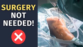 Treat Meniscus Injury Without Surgery