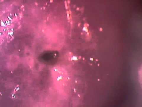 Exame de colposcopia com biopsia