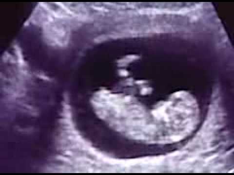 fetus at 12 weeks. Our aby 12 weeks old