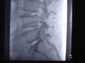 4.DISCOLISIS LUMBAR EN 3 ESPACIOS EN PACIENTE CON CIRUGIA DE COLUMNA PREVIA