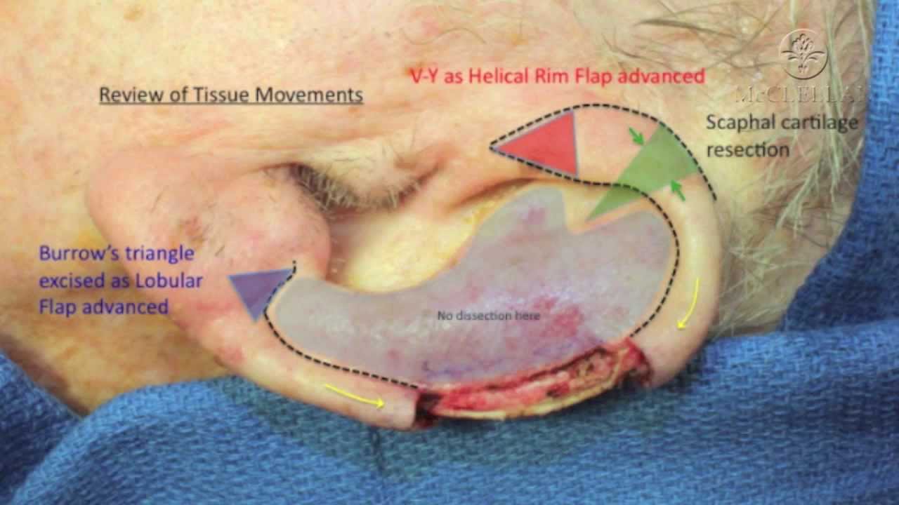stage 1 grade three cervical most cancers cervical most cancers best caused by hpv