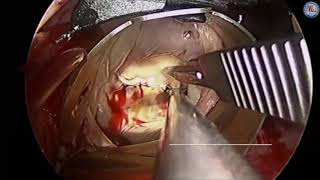 Minimally invasive transatrial mitral valve replacement in mitral annular calcification