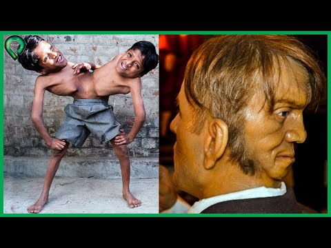 1 Tỷ Người Mới Có 1 | Top 10 Cặp Song S.i.n.h Dính Liền Hy Hữu Nhất Mọi Thời Đại