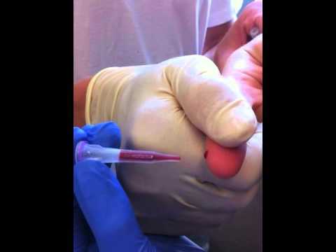Blood collection using capillary tube for serology