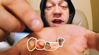 LOST 4 TEETH