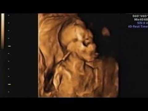 3d ultrasound pictures at 20 weeks. 3D (4D) Ultrasound Baby Boy 19/20 Weeks. 3D (4D) Ultrasound Baby Boy 19/20 Weeks. 3:19. Ultrasound and 3-D/4-D ultrasound. It#39;s a boy!