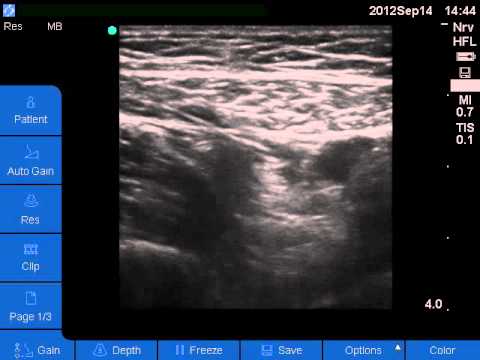 femoral nerve block ultrasound guided femoral nerve block ultrasound guided, Muscles