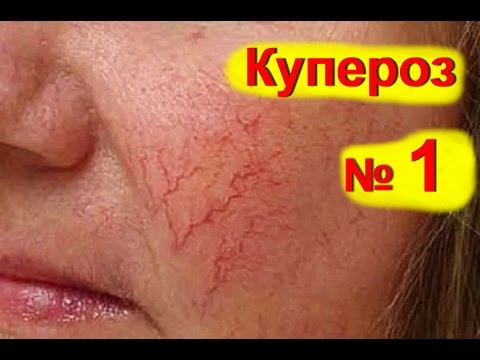 Купероз лица лечение в домашних условиях Купероз лица лечение в домашних условиях