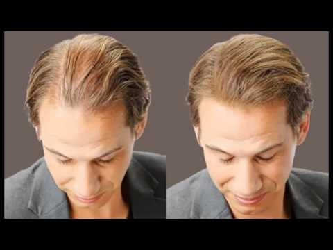 caída del cabello caída del cabello
