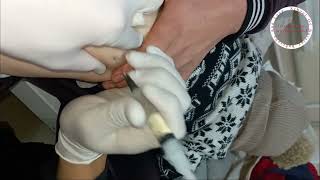 intramuscular injection buttock to child . A shot in the buttock. intramuscular 