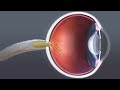(Audio Description) Animation: Cataract