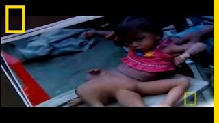 The Girl With Eight Limbs National Geographic