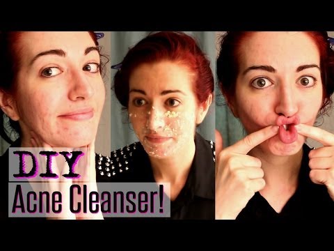 Acne Treatment Oily CLEANSER! Natural For Skin ACNE face EASY &  diy mask skin acne for prone