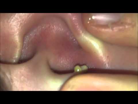 ear-blackhead-removal