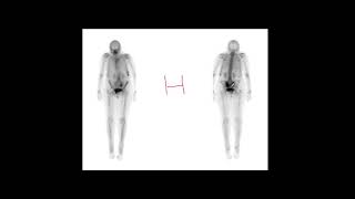 Bone Scintigraphy Vi Miscellaneous Fractures