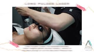 Combination Laser Treatment | Astute Medical Aesthetics & Laser Clinic
