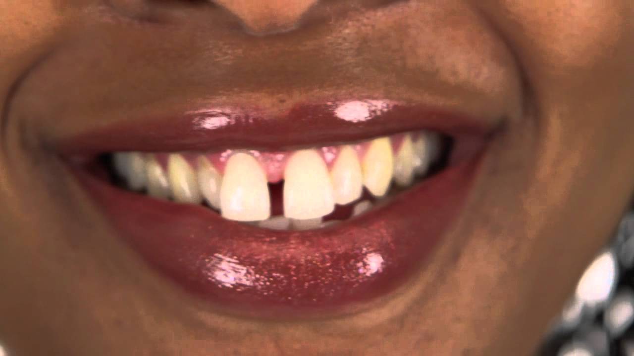 teeth gaps gapped close