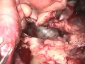 Removal of Cardiac Tumor. Arie Blitz, MD