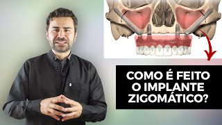 Como é Feito o Implante Zigomático?