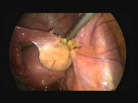 Cervical most cancers symptoms mumsnet cervical ligament foot